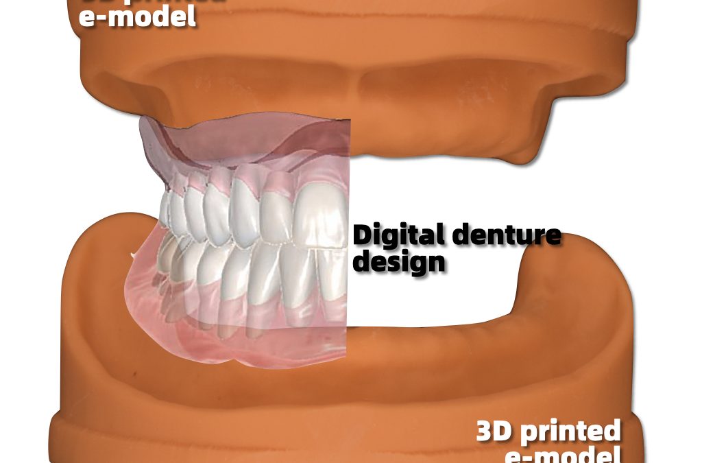 How to do dentures digitally – based on intraoral scanning edentulous patients